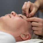 mulher madura em sessão de acupuntura
